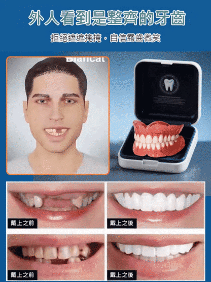 【英國新研究成果】矽膠仿真牙齒牙套