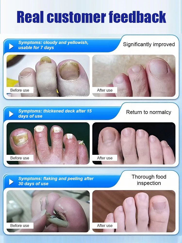 Antifungal nail solution