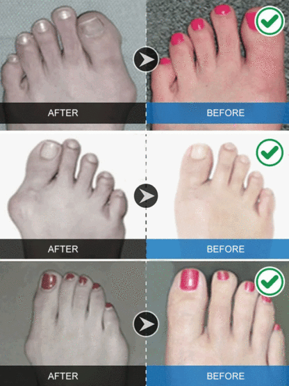 [Buy 1 Free 2] Unisex invisible corrective five-toe socks