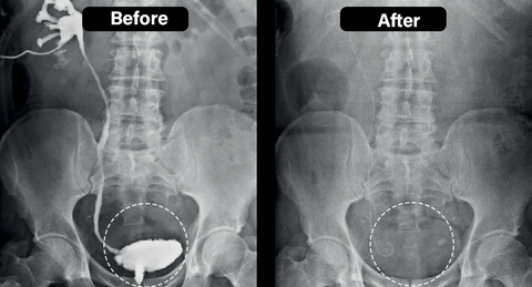 LOVILDS™ BeeBoom Nasal Inhaler For Prostate Wellness