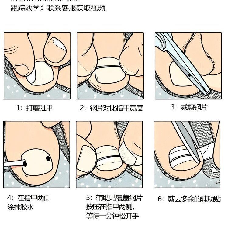 Ingrown Toenail Correction Durable Tension Patch