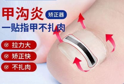Ingrown Toenail Correction Durable Tension Patch
