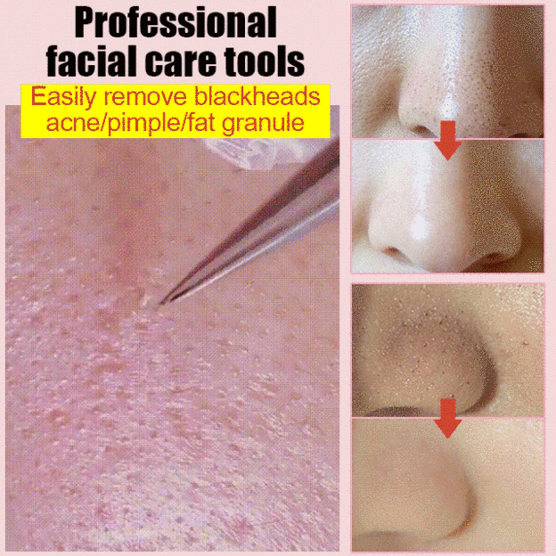 Stainless steel acne and blackhead remover tweezers