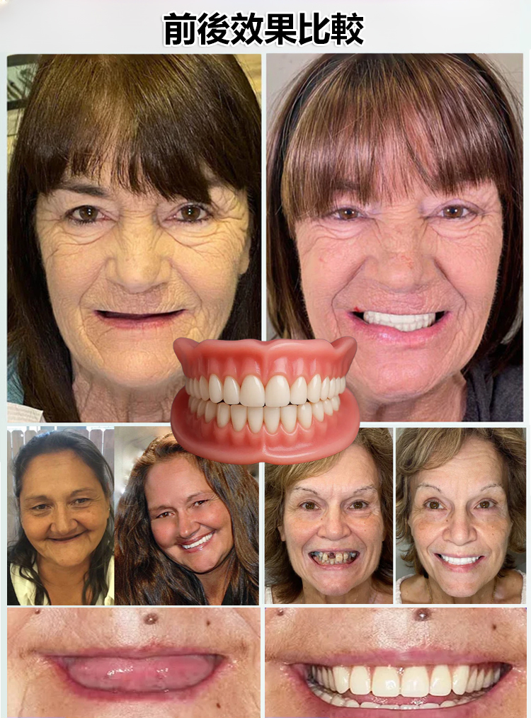 自然貼合全包上下舒適假牙套