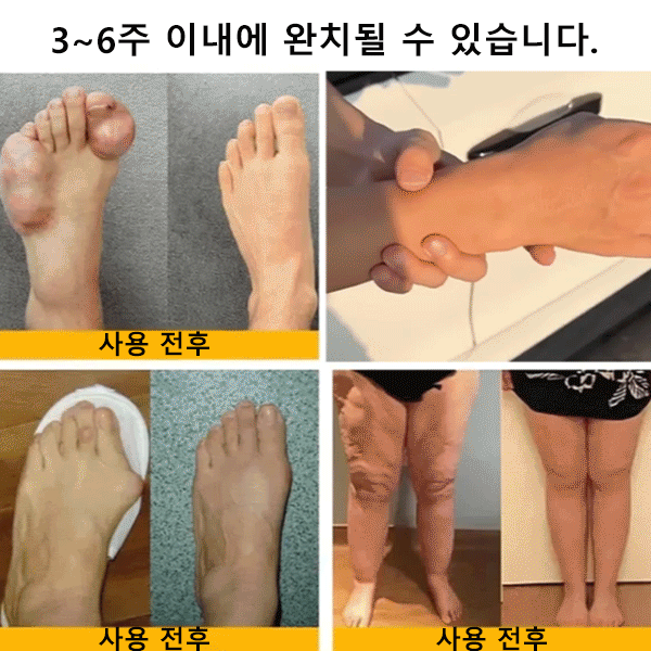 관절 완화 통기 케어 패치