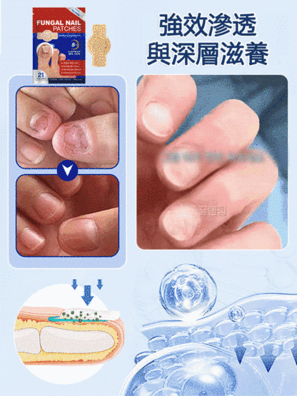 指甲修護矯正抑菌貼