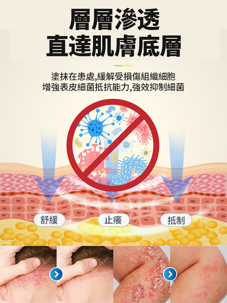 【想癢都難】止癢抑菌皮膚修復膏