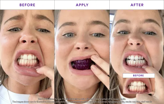 5D Whitening Strips