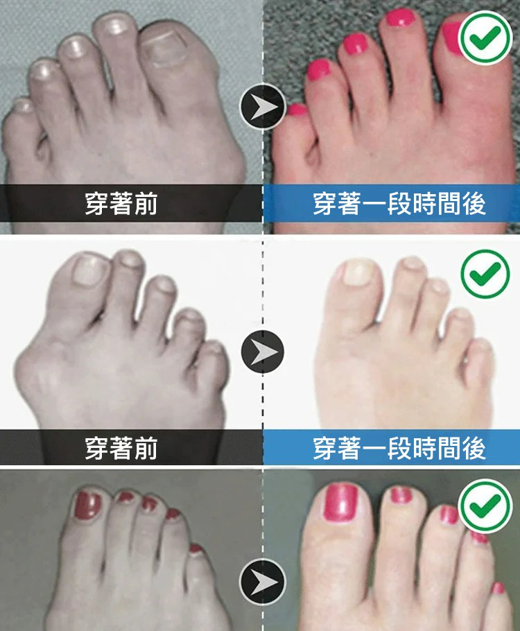 【防滑防臭】男女通用隱形校正五指襪