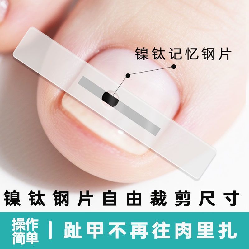 矯正嵌甲持久拉力貼片