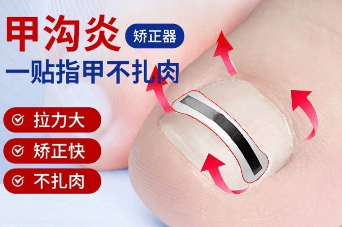 矯正嵌甲持久拉力貼片