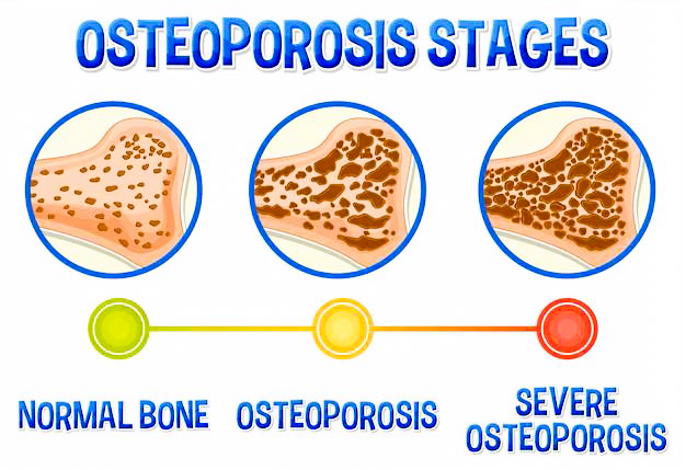 E P osteo stages