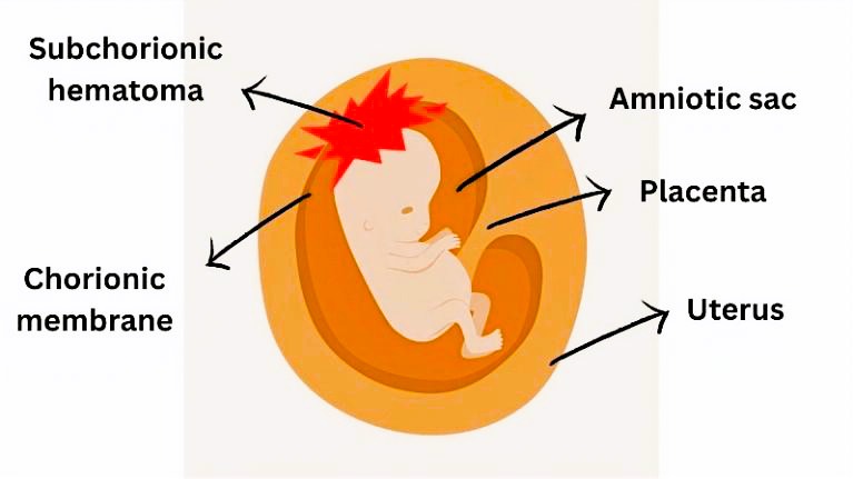 Hematoma fetus