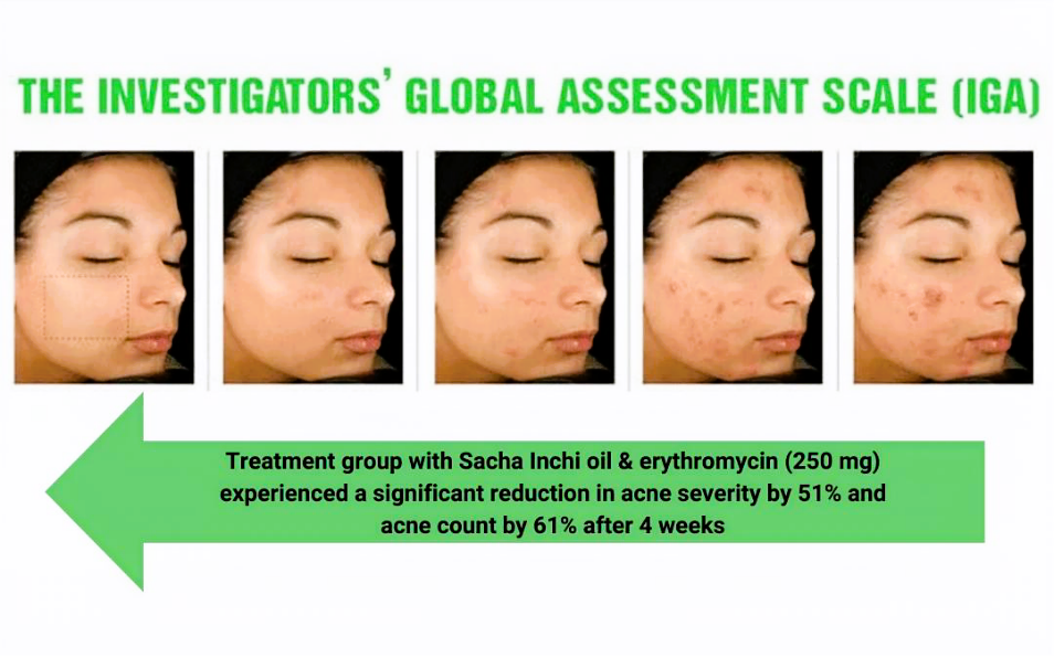 PUNCH severe acne scale