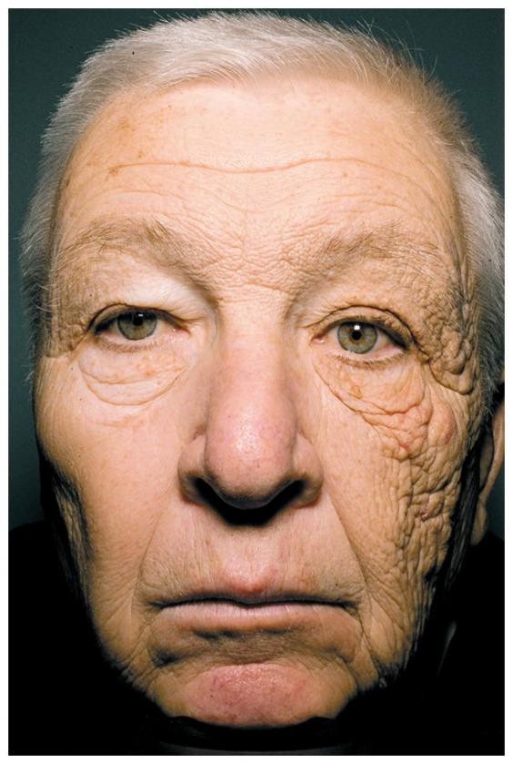 trucker damaged skin