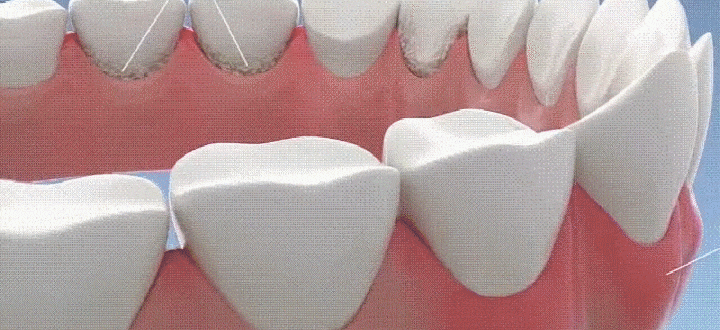 翻译件-JC-真超声波洁牙器-1143252_24-1.gif