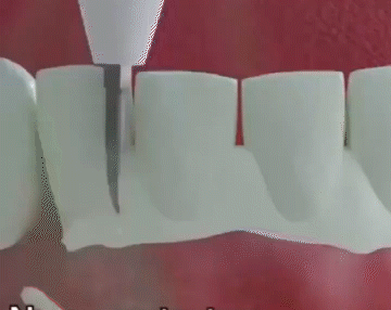 翻译件-JC-真超声波洁牙器-1143252_19.gif
