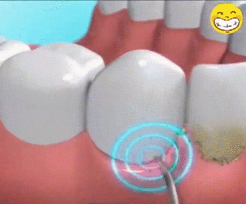 翻译件-JC-真超声波洁牙器-1143252_12-1.gif