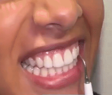 翻译件-JC-真超声波洁牙器-1143252_15-1.gif