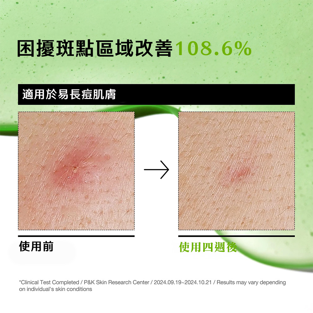 【台灣現貨】Anua 壬二酸10+玻尿酸抗痘抗紅修護精華液30ml 提亮 控油 舒緩保濕 改善泛紅