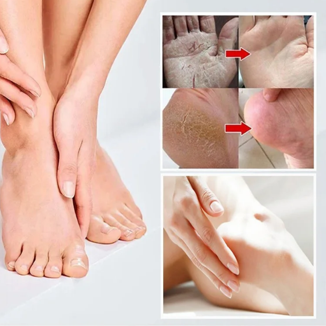 Tea tree oil hand and foot cream