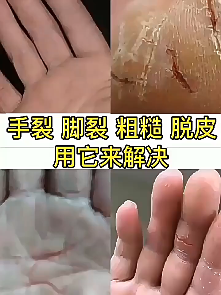 뒤꿈치 각질제거 크림 손발 튼살 케어 갈라진 피부 보습 마유 풋크림 고보습 영양