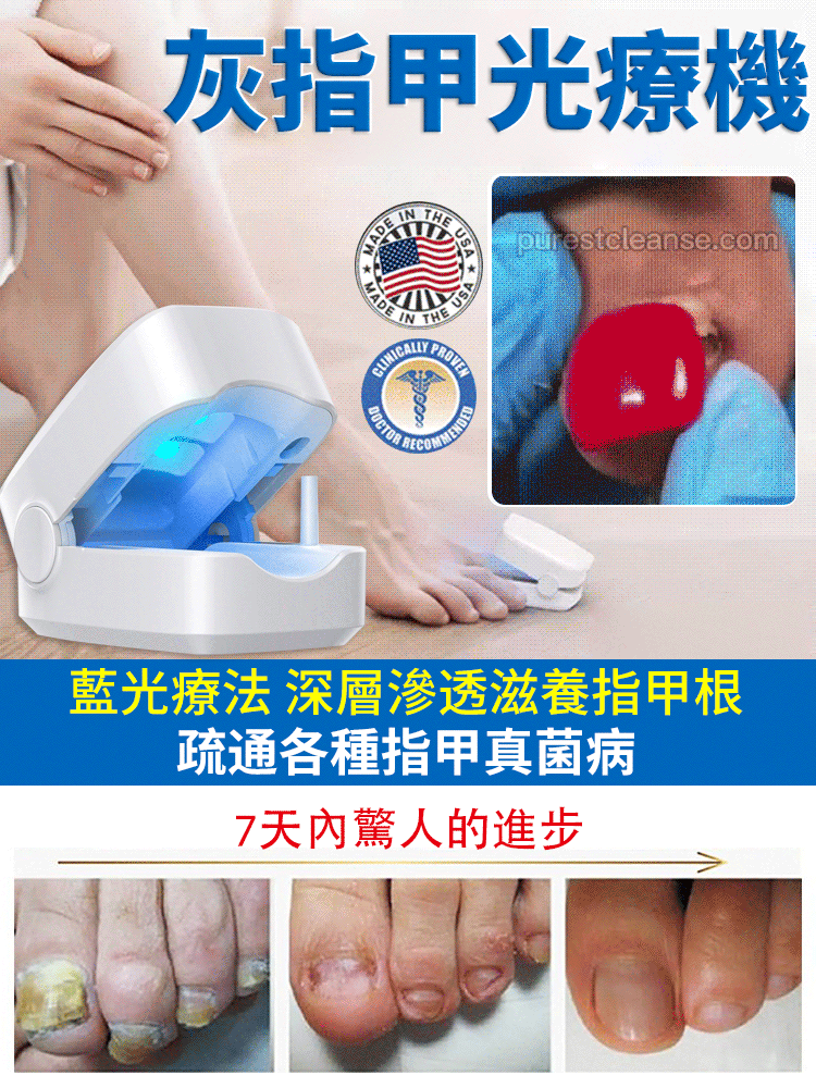 灰指甲光療機