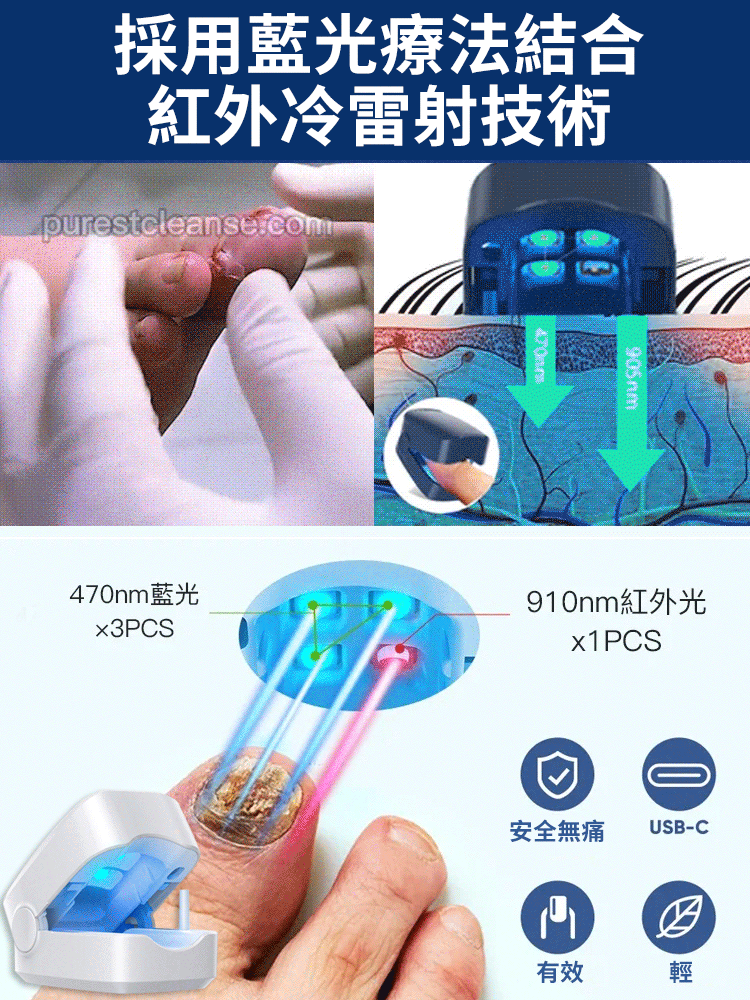灰指甲光療機