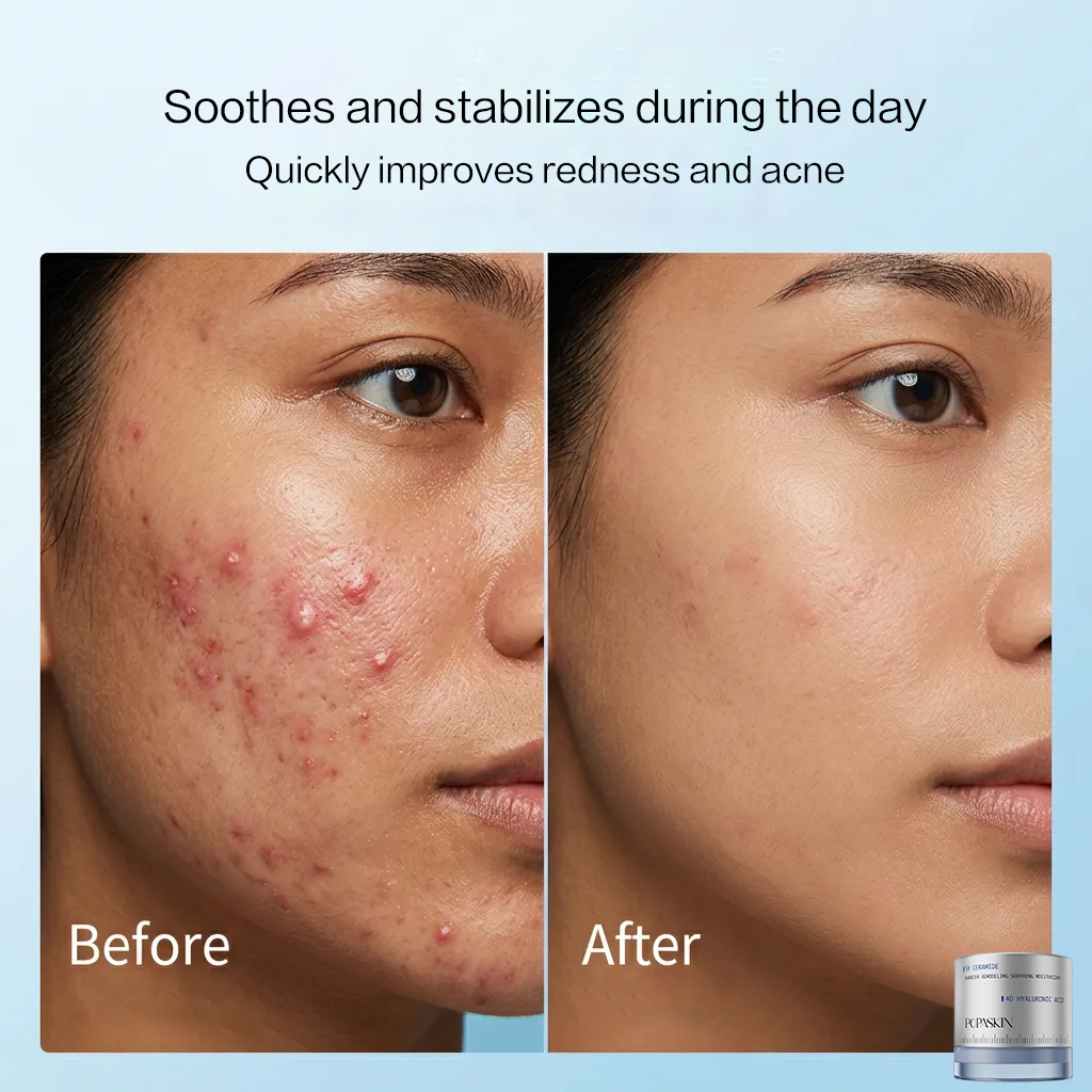 【KOL】 POPASKIN 5X Ceramide Barrier Soothing Moisturizer & 577 Dark Spot Cream: A skincare set for radiant skin, strengthening the skin barrier, reducing recurring acne, clearing dark spots, and revealing glass skin. Suitable for sensitive, acne-prone, and