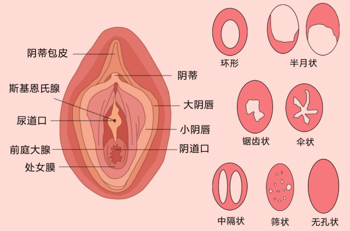 處女膜結構示意圖與醫學解釋