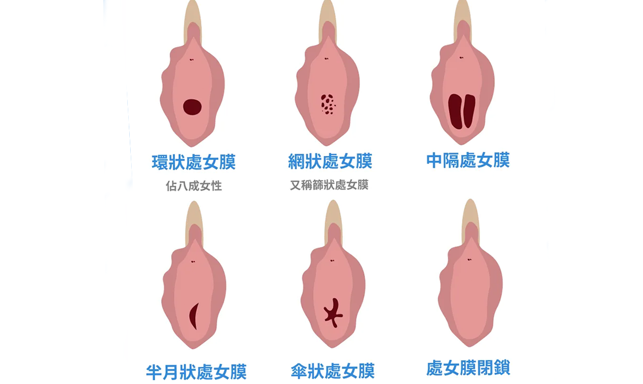 處女膜結構示意圖與醫學解釋