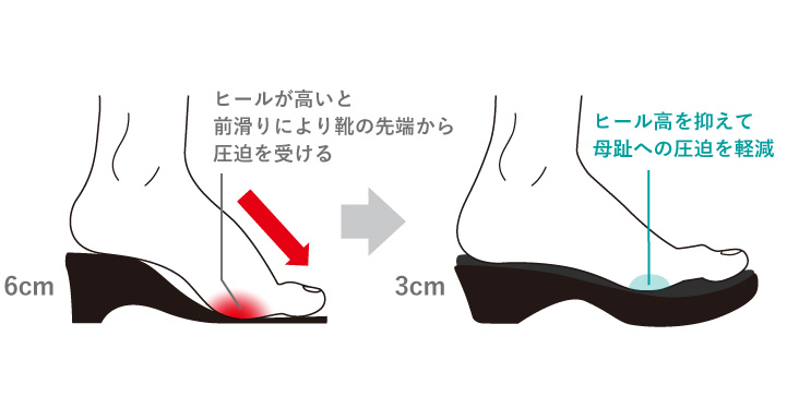 ヒールが高くなるにつれ靴の先端からの圧迫が増し、母趾の変形が進む