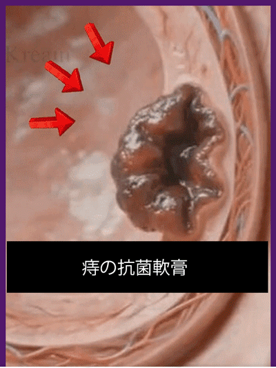痔の抗菌軟膏