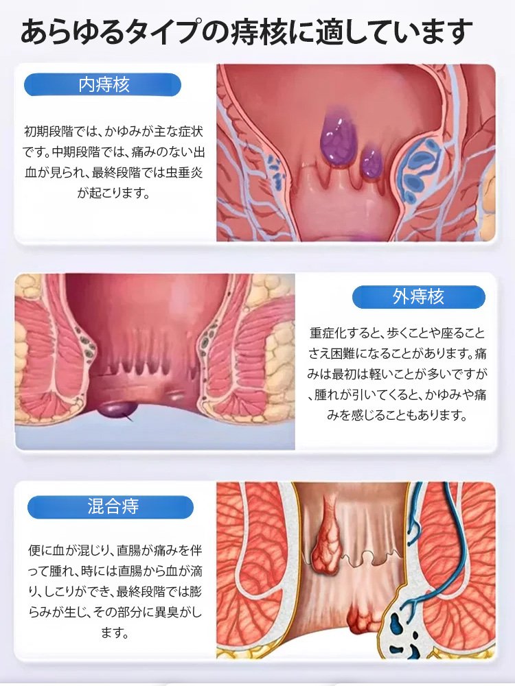 痔の抗菌軟膏
