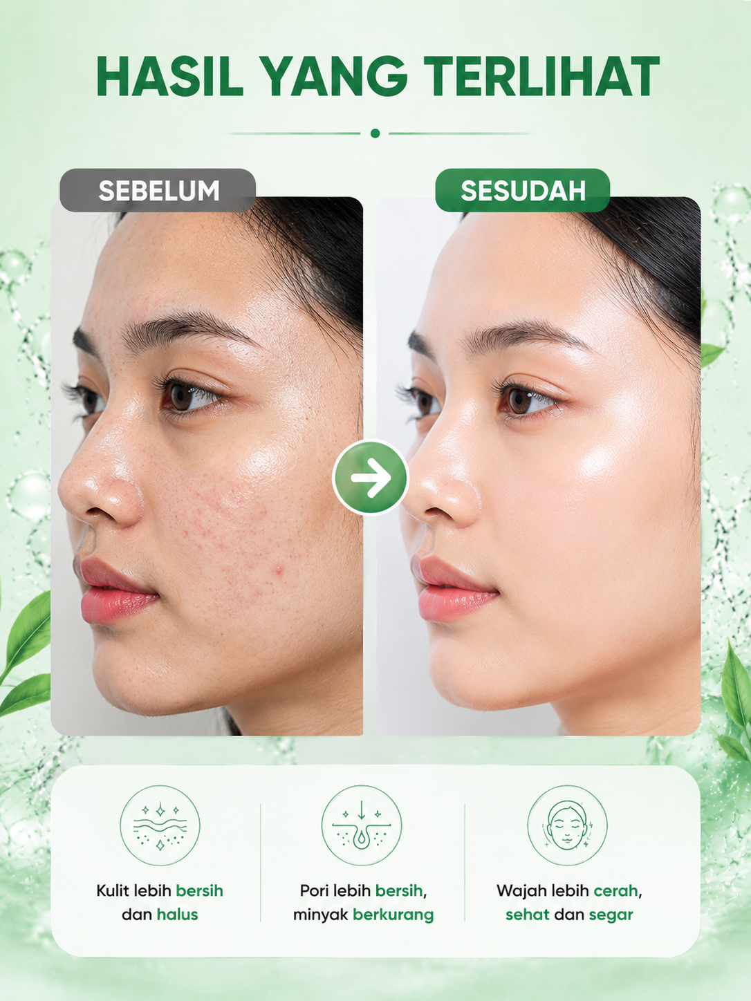 KORMESIC 5in1 Intense Acne Solution Facial Wash - Sabun Cuci Muka Anti Acne Pembersih Jerawat & Kontrol Minyak
