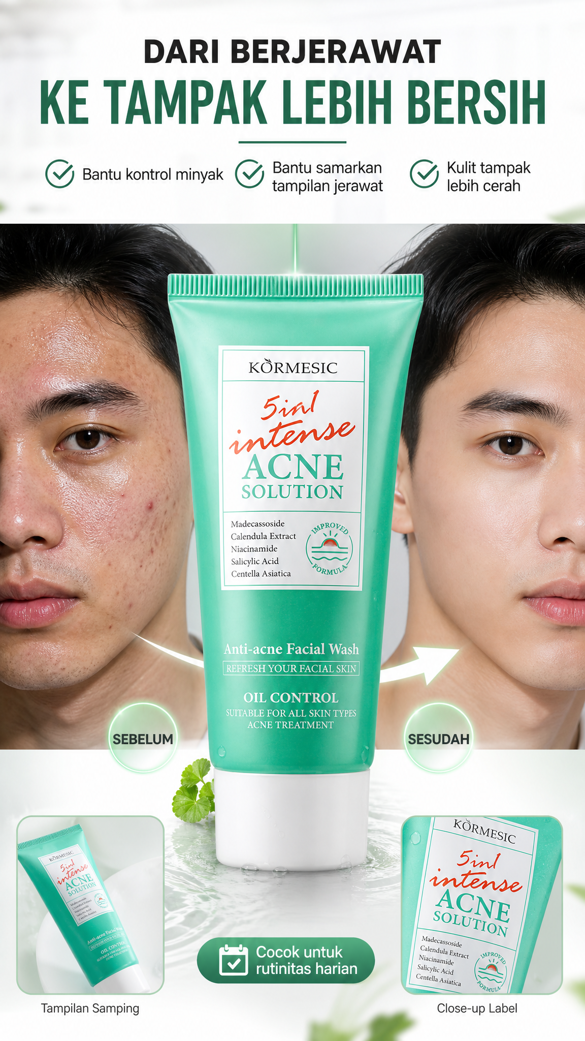 KORMESIC 5in1 Intense Acne Solution Facial Wash - Sabun Cuci Muka Anti Acne Pembersih Jerawat & Kontrol Minyak