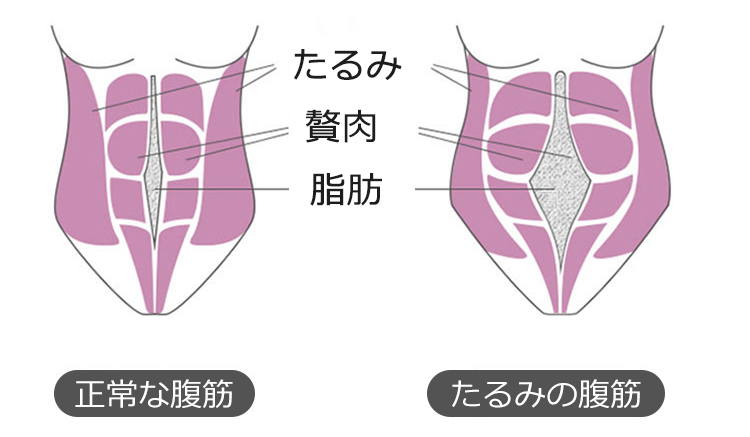補正下着 腹筋