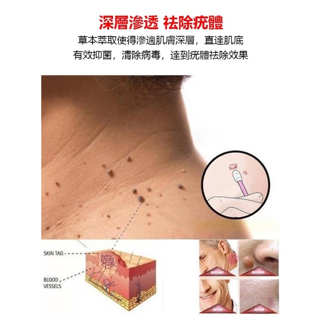 超夯祛疣膏，一抹就祛疣，無需激光手術，輕鬆祛除，安全有效！