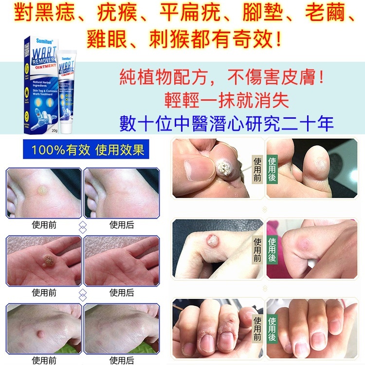超夯祛疣膏，一抹就祛疣，無需激光手術，輕鬆祛除，安全有效！