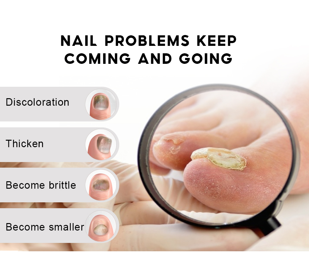 Toe Nail Fungus Treatment Cream Anti Fungal Nail Infection Kit Solution  Tools | eBay