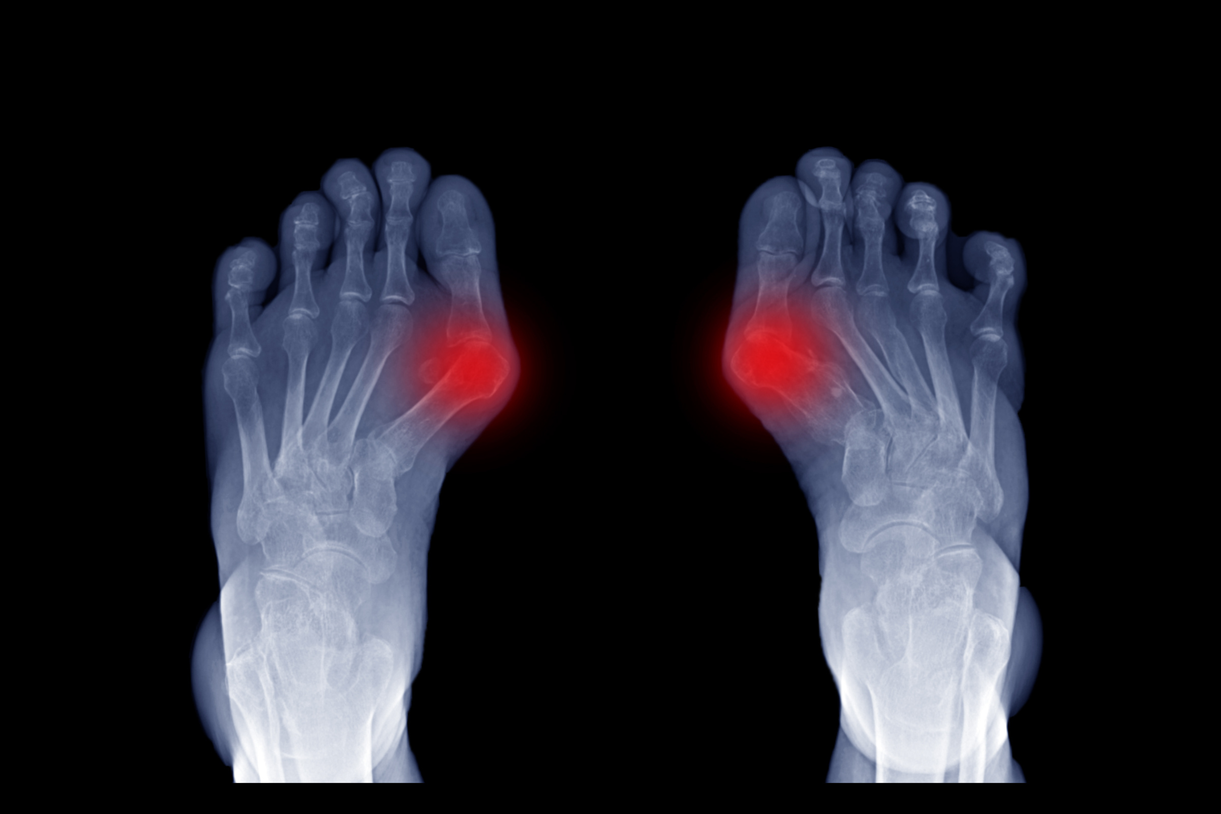 What are Bunions and Why Should You Care?-Sunnystep-The most comfortable walking shoes-Best walking shoes