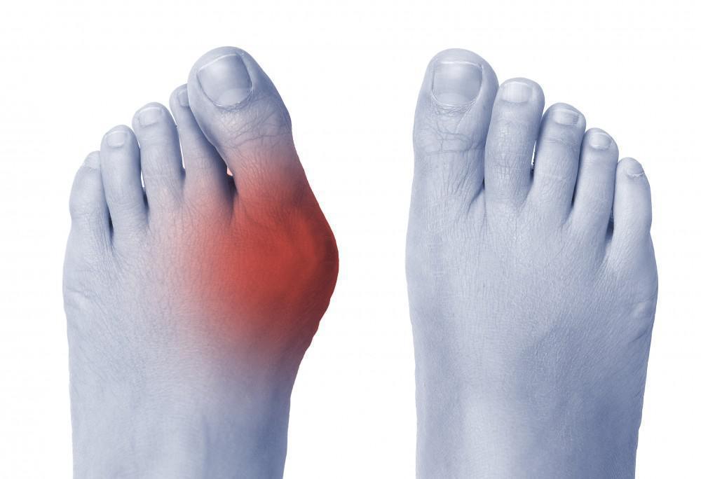 Don’t Overlook Your Bunion! May Affect your Posture Result in Pain-HAPPY WALKER